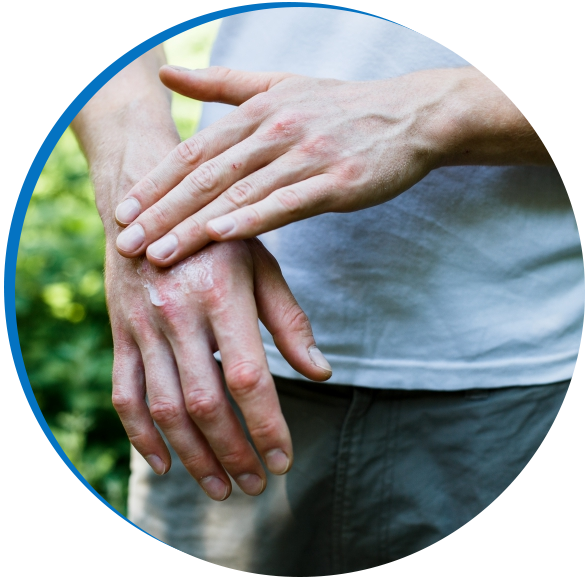 Eczema