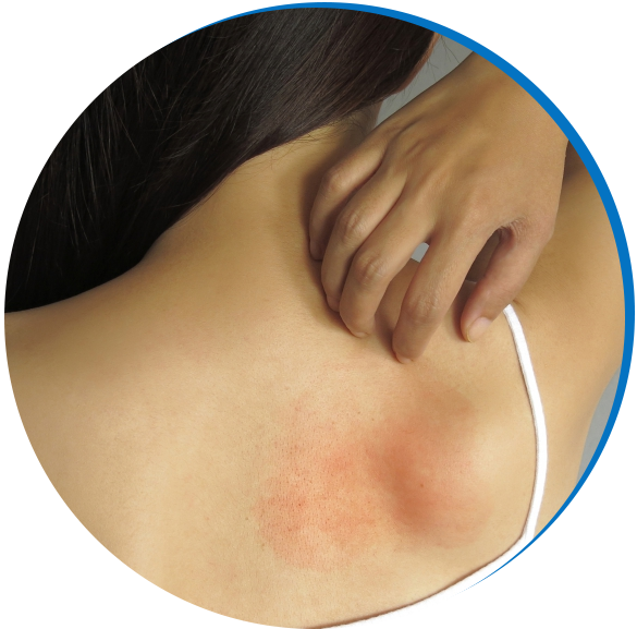 Psoriasis