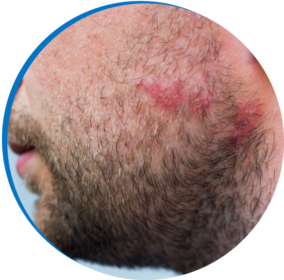 Rash_
