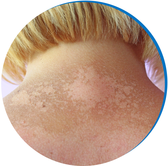 Skin Cancer